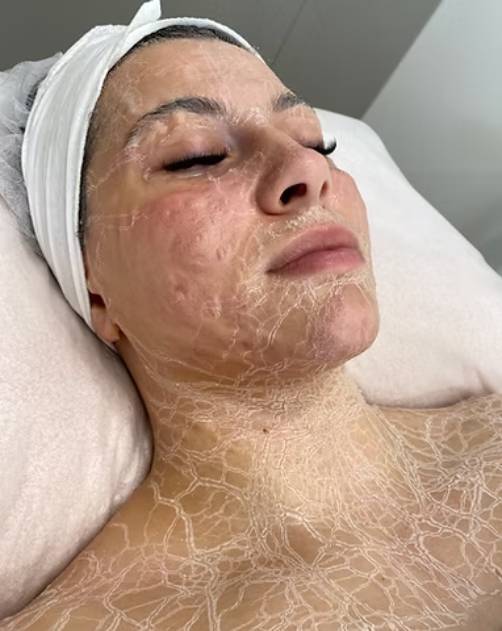 Enzyme treatments revise the skin by removing toxins & rebuilding the skin with oxygen & blood supply