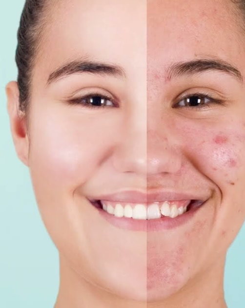 Professional acne treatments to adress hormonal imbalances, poor diet, reactive skin.